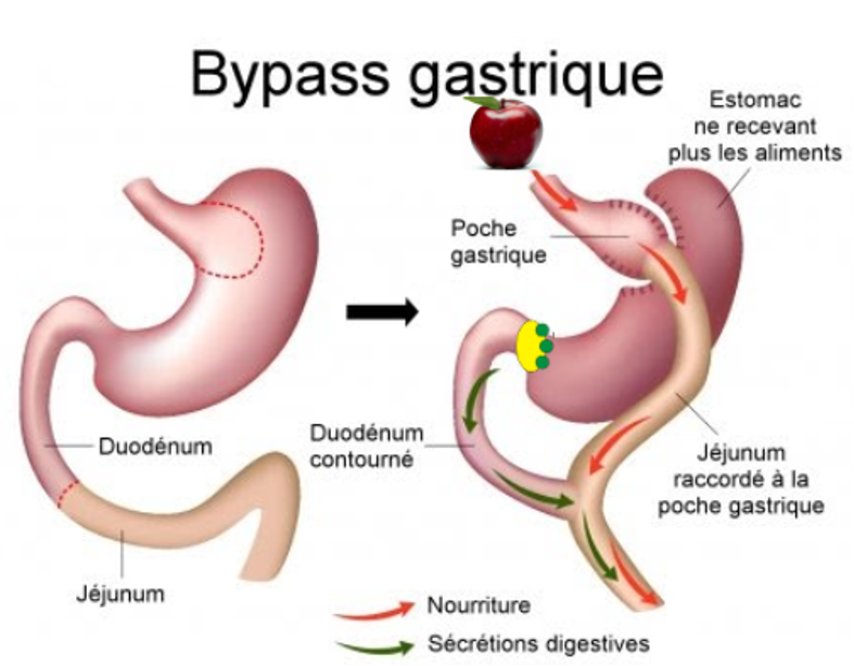 bypass gastrique