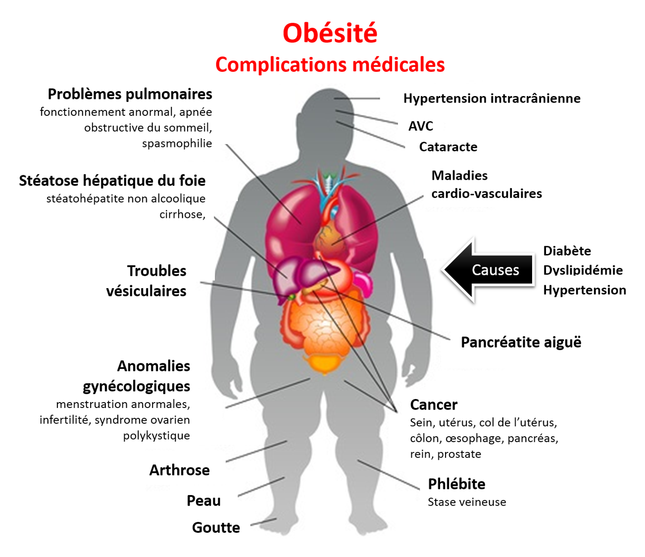 obesite complications